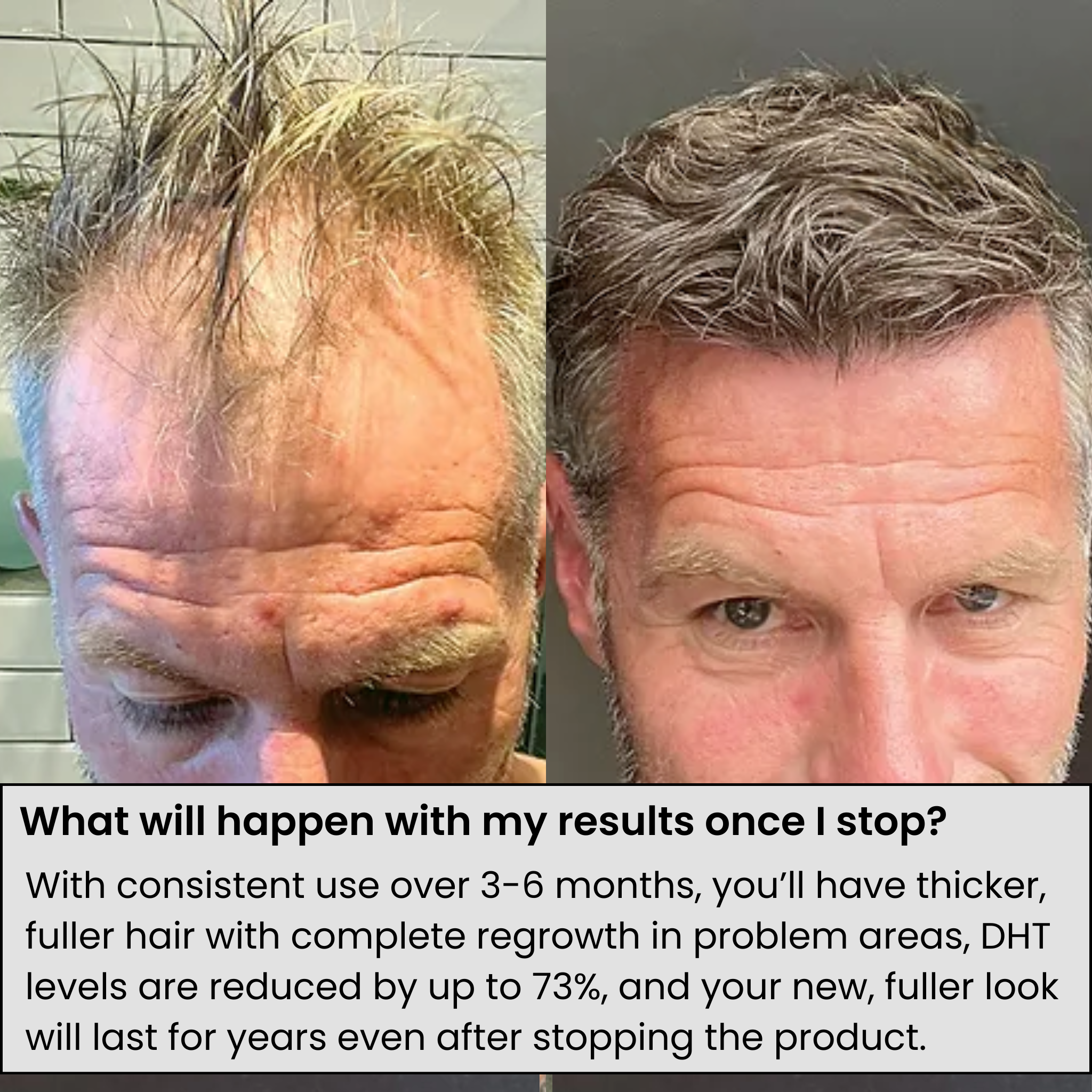 AlphaInfuseβ’ Hair Regrowth System