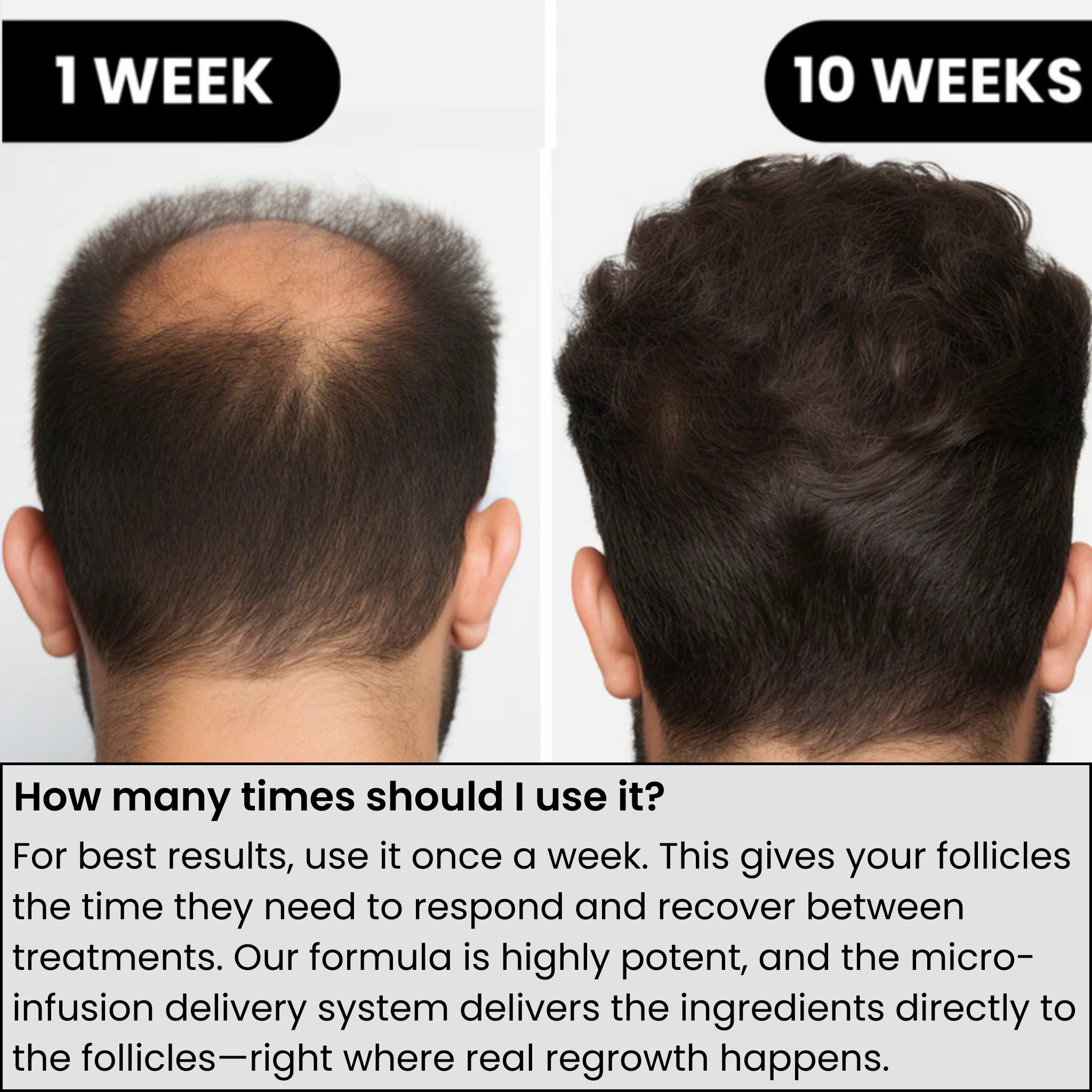 AlphaInfuse™ Hair Growth System