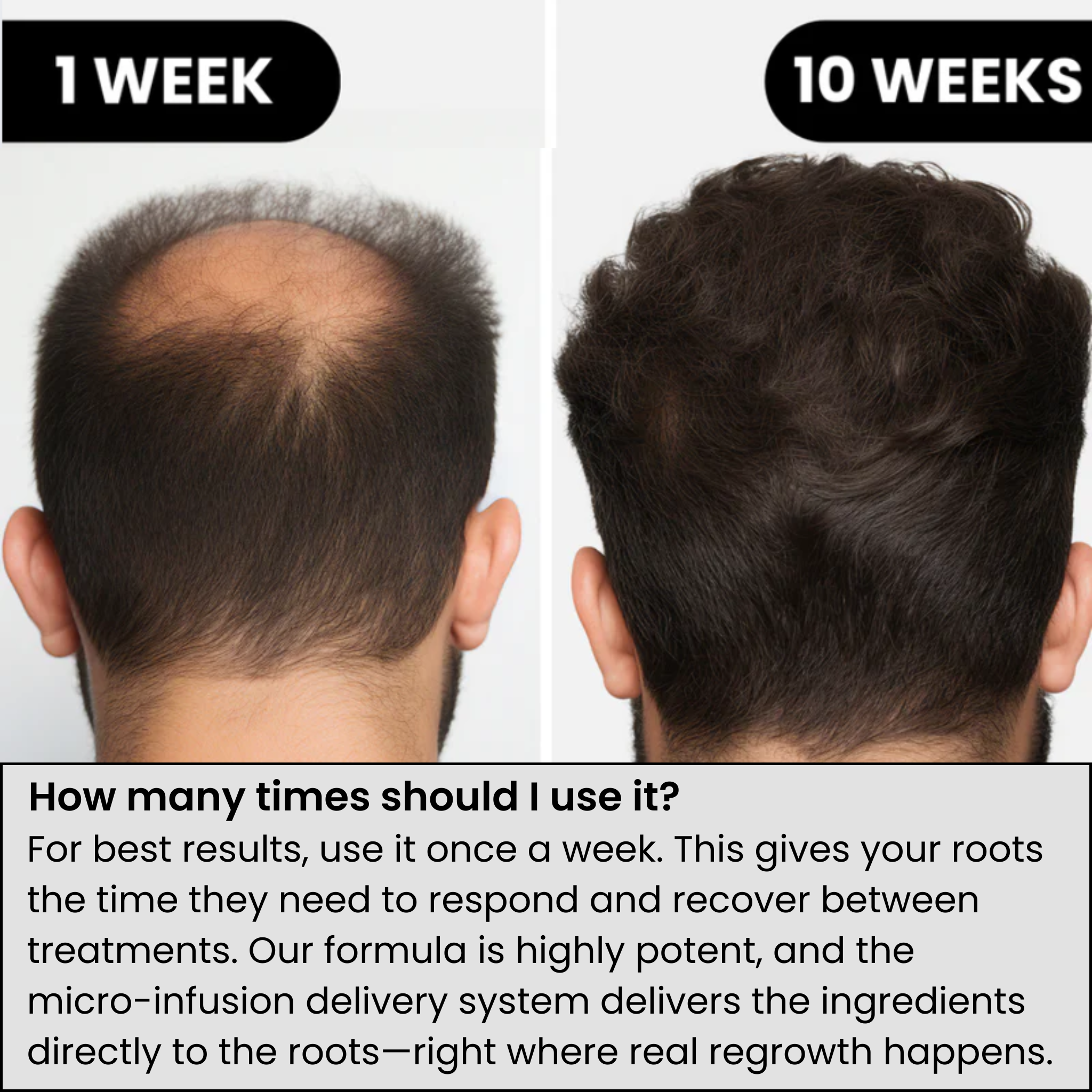 AlphaInfuseβ’ Hair Regrowth System