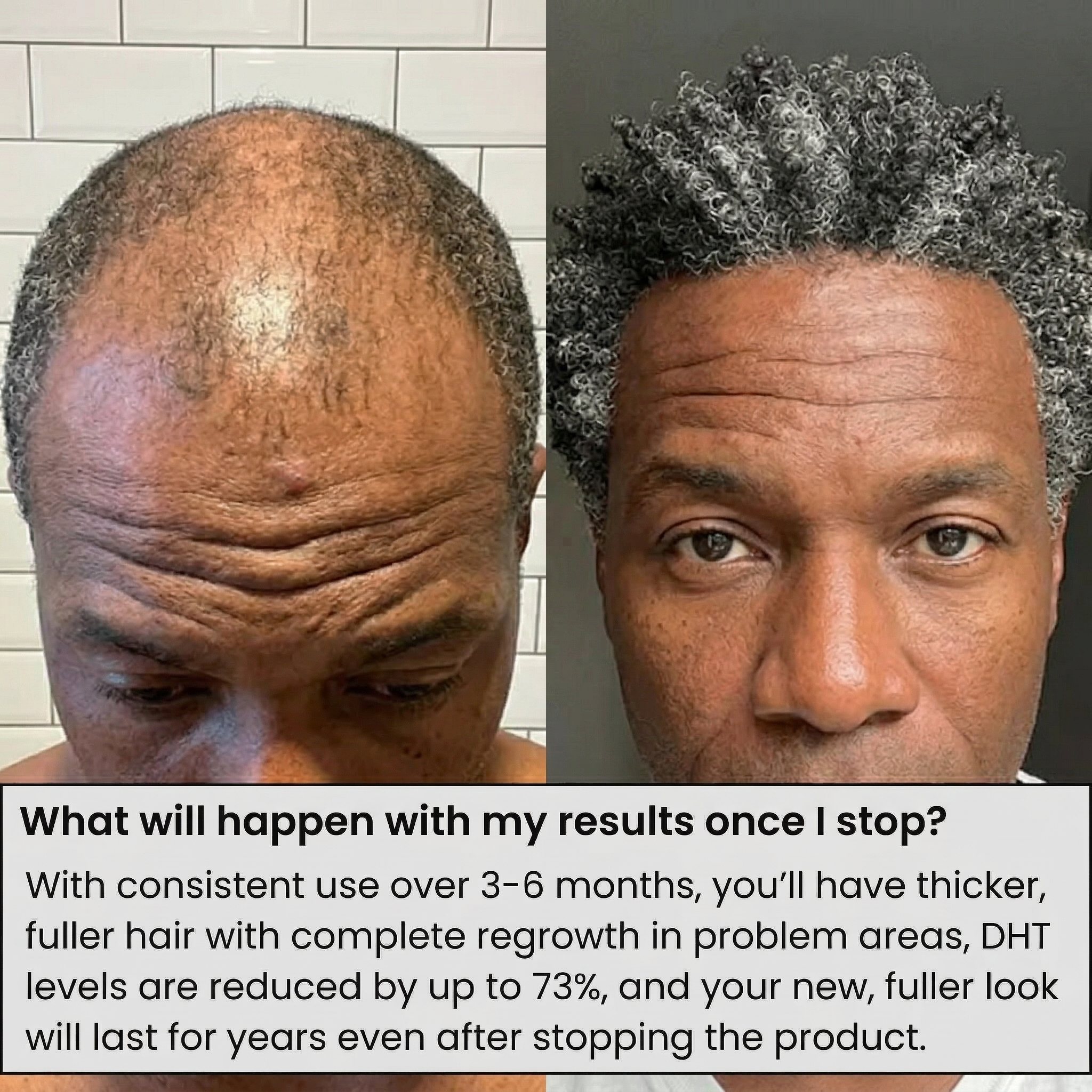 AlphaInfuse™ Hair Regrowth System