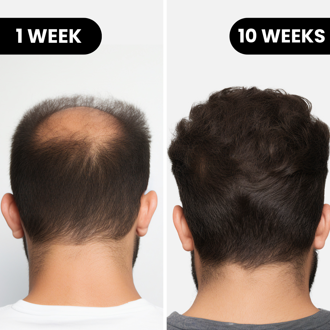 Louxlue Hair Growth Results